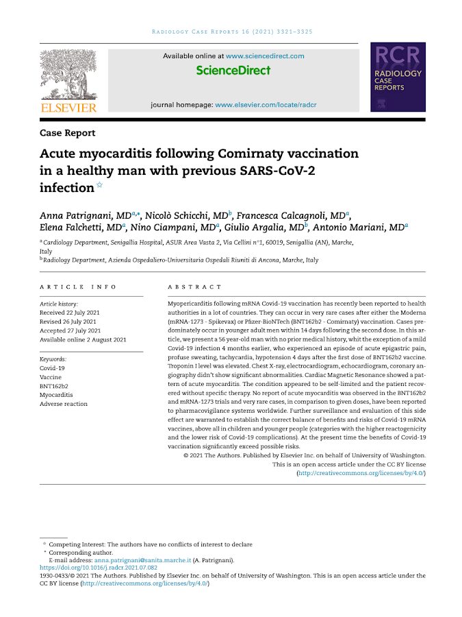 Elsevier – Acute myocardit is following Comirnaty vaccination in a healthy man with previous SARS-CoV-2 infection