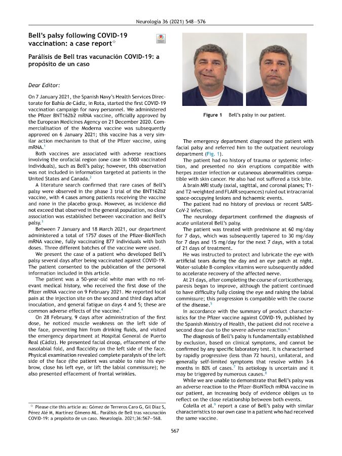 Neurologia – Bell’s palsy following COVID-19 vaccination: a case report